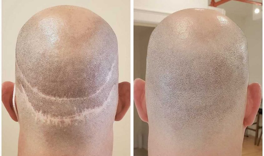 Scalp-Micropigmentation-Perth-10